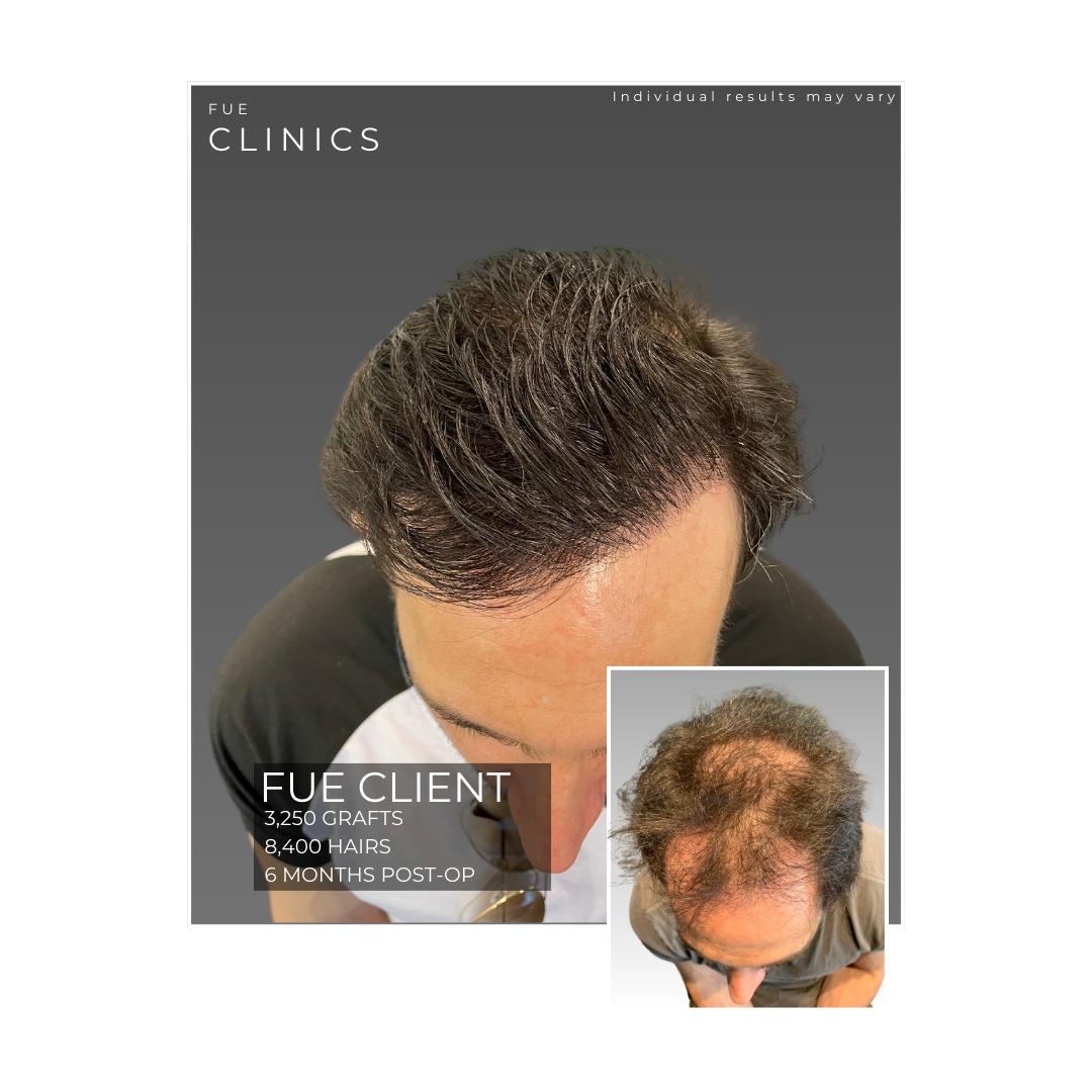 60 Fue Clinics 1