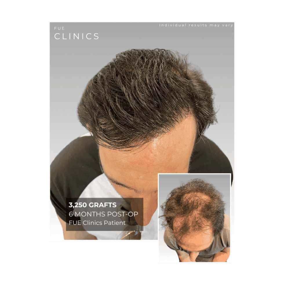 80 980x980 compressed Fue Clinics 1